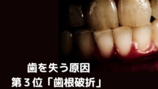 日本人が歯を失う原因第3位は「歯根破折（しこんはせつ）」