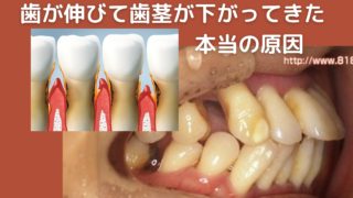 歯茎が下がって歯が伸びてきた。原因は？