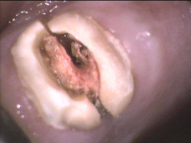 歯を削らない治療・歯を抜かない治療なら香川県 高松市 薬で治す歯科治療の吉本歯科医院