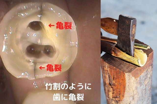 歯のヒビ、歯が割れる、歯根破折 原因と対処方法|香川県 高松市 咬み合わせ専門吉本歯科医院