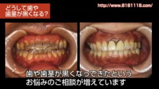 神経を抜いた歯の色が茶色く変色しているのを白い歯にしたい