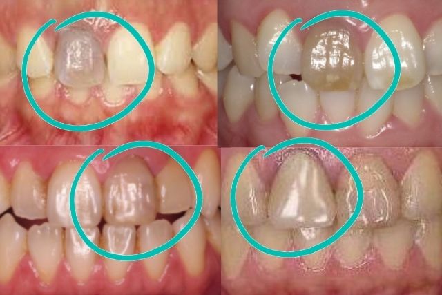 神経を取った歯が変色しているのを白くしたい|香川県 高松市 審美歯科なら吉本歯科医院