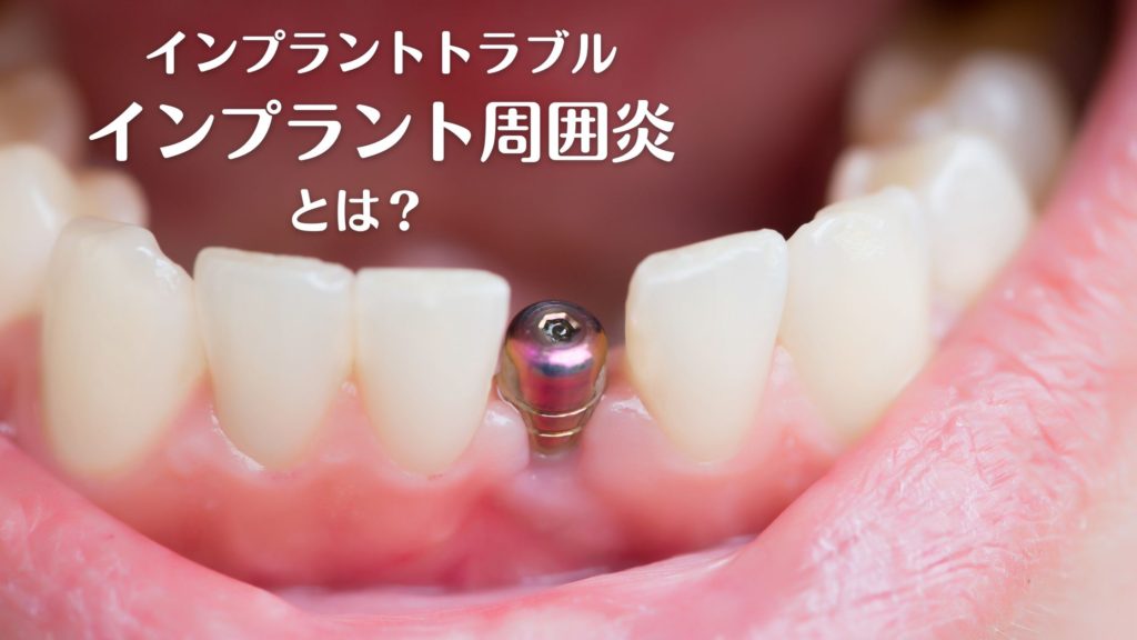 インプラント周囲炎とは？｜香川県高松市の咬み合わせ専門　吉本歯科医院
