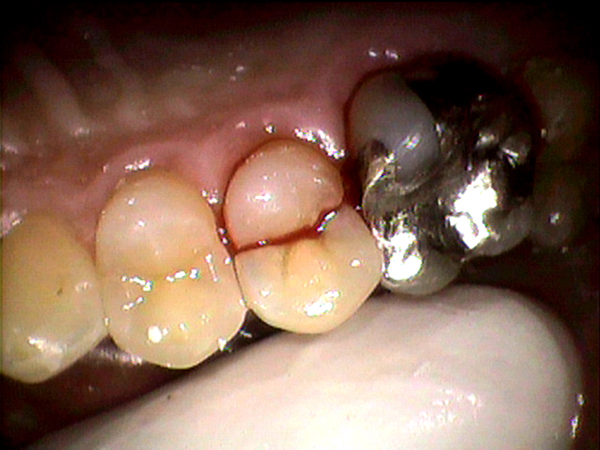 歯の神経のお痛みなら香川県高松市の歯の神経治療専門歯科 吉本歯科医院