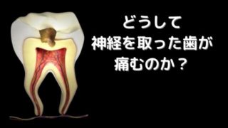 神経を取った歯が痛い！どうして？