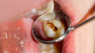 歯磨きさえしていれば虫歯にならないと思っていませんか？