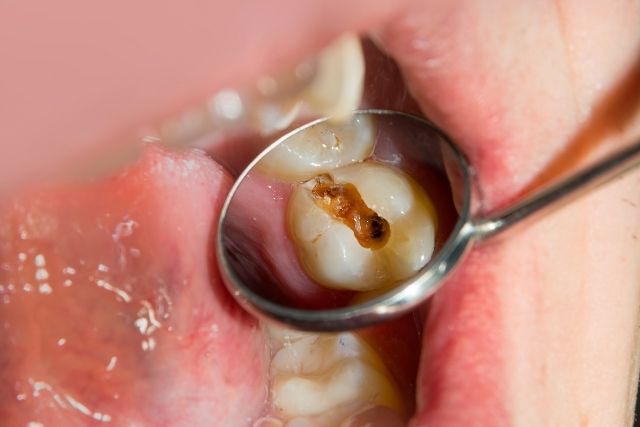 虫歯を削らず薬で治す治療なら香川県高松市の吉本歯科医院