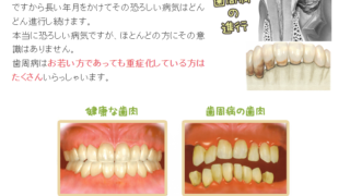 20代でも歯周病が重症化します。