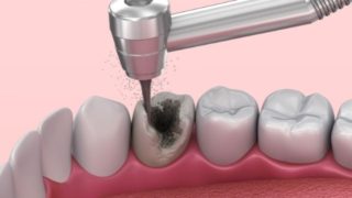 虫歯は薬で治すことができる