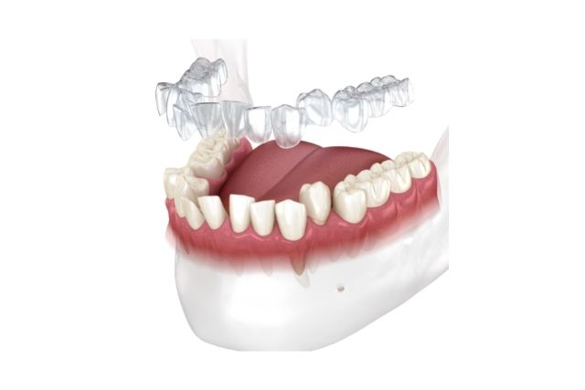 目立たない矯正|マウスピース矯正なら高松市の吉本歯科医院