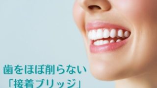 歯を削るのではなく接着する「接着ブリッジ」