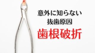 意外に知らない抜歯原因「歯根破折（しこんはせつ）」