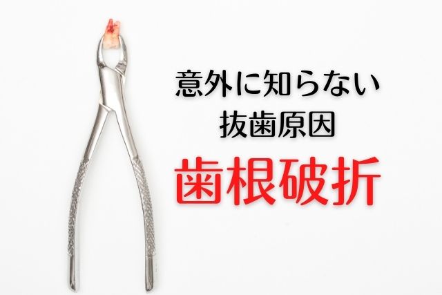 歯を抜かない治療|歯根破折で抜歯診断|香川県高松市の吉本歯科医院