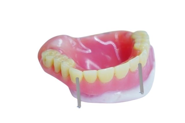 歯を抜かない治療|歯根破折による抜歯から歯を守るなら香川県高松市の吉本歯科医院