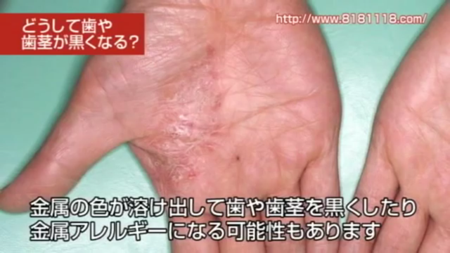 差し歯の歯茎が黒い・歯と歯茎の境目の黒ずみが気になる方へ｜高松市の吉本歯科医院