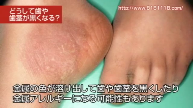 差し歯の歯茎が黒い・歯と歯茎の境目の黒ずみが気になる方へ｜高松市の吉本歯科医院