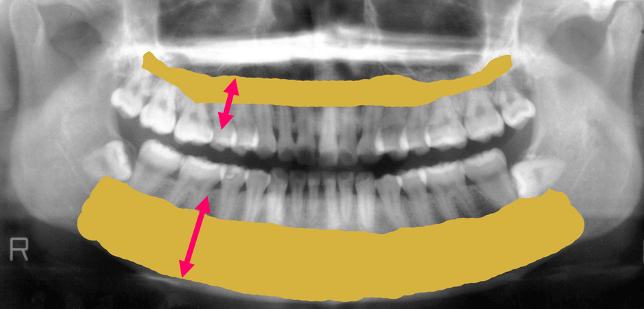 吉本歯科医院 インプラント 治療 患者様の体験談|香川県 高松市