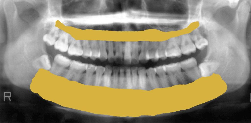 吉本歯科医院 インプラント 治療 患者様の体験談|香川県 高松市
