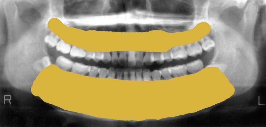 吉本歯科医院 インプラント 治療 患者様の体験談|香川県 高松市