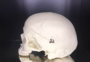 吉本歯科医院 インプラント 治療 患者様の体験談|香川県 高松市