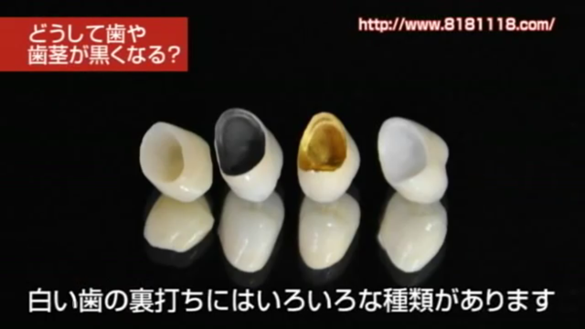 差し歯の歯茎が黒い・歯と歯茎の境目の黒ずみが気になる方へ｜高松市の吉本歯科医院