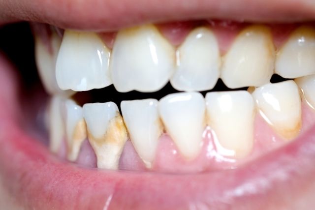 吉本歯科医院 インプラント 治療 患者様の体験談｜香川県 高松市