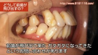 昔に比べて前歯が飛び出してきた方へ