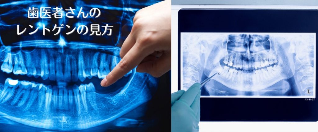 吉本歯科医院 インプラント 治療 患者様の体験談|香川県 高松市