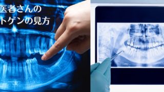 歯科のレントゲン写真の見方