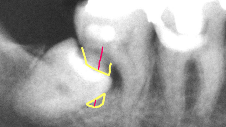 吉本歯科医院 インプラント 治療 患者様の体験談|香川県 高松市