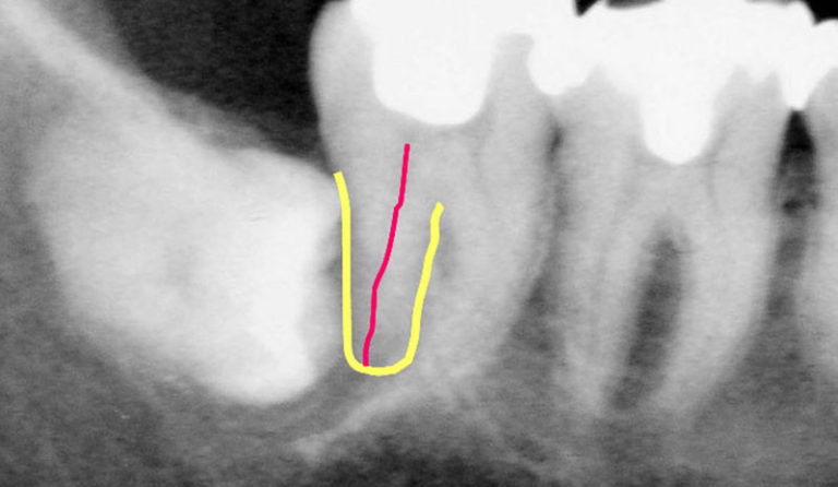 吉本歯科医院 インプラント 治療 患者様の体験談|香川県 高松市
