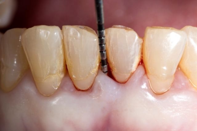 抜歯しない歯周病治療なら吉本歯科医院