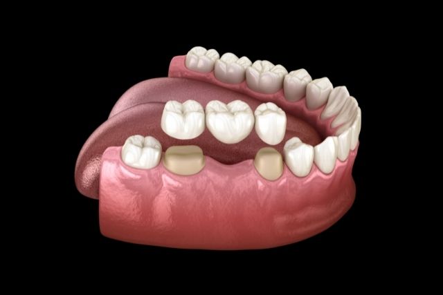 ブリッジした歯が痛くなる原因｜香川県高松市のインプラント治療なら吉本歯科医院