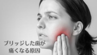 ブリッジした歯が痛くなる原因