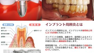 え？インプラントも歯周病になる？