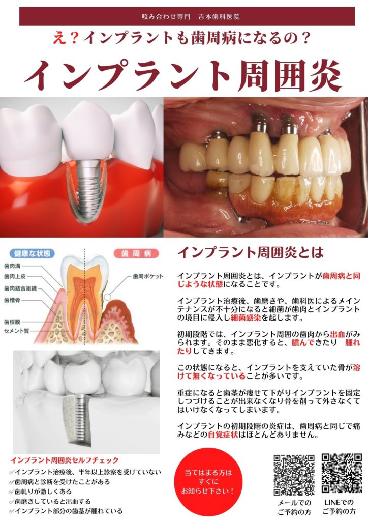 吉本歯科医院 インプラント 治療 患者様の体験談｜香川県 高松市