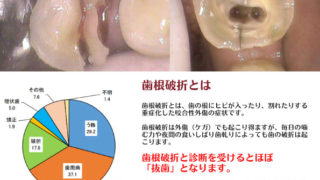 知っていれば防げた破折原因