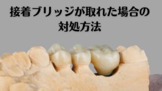過去にした接着ブリッジが取れた時の対処方法
