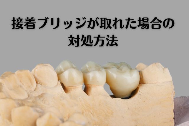 接着ブリッジが取れた時の対処方法｜歯を削らない接着ブリッジ治療なら吉本歯科医院