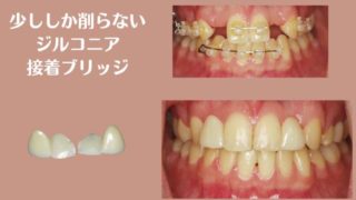 歯を削る量が少ないジルコニア接着ブリッジ