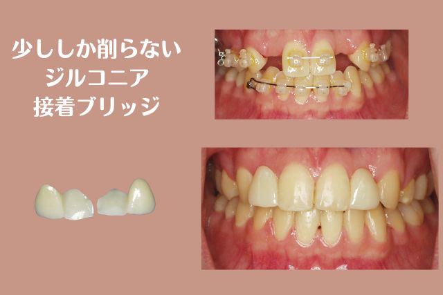 歯を少ししか削らないジルコニア接着ブリッジ｜高松市の吉本歯科医院