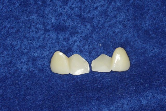 歯を少ししか削らないジルコニア接着ブリッジ｜高松市の吉本歯科医院