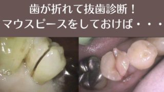 歯が折れて抜歯診断！マウスピースをしておけば・・・