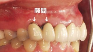 差し歯とは虫歯などで歯を削った後に被せる歯の被せ物のこと