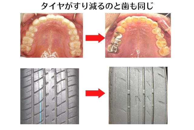 歯が割れる|高松市の吉本歯科医院