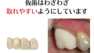 仮歯は見た目をよくするためだけではありません