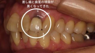 差し歯と歯茎の境目が黒くなってきた