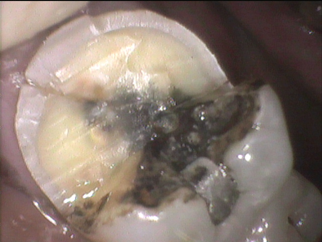 歯根破折|高松市で歯を残す治療なら吉本歯科医院