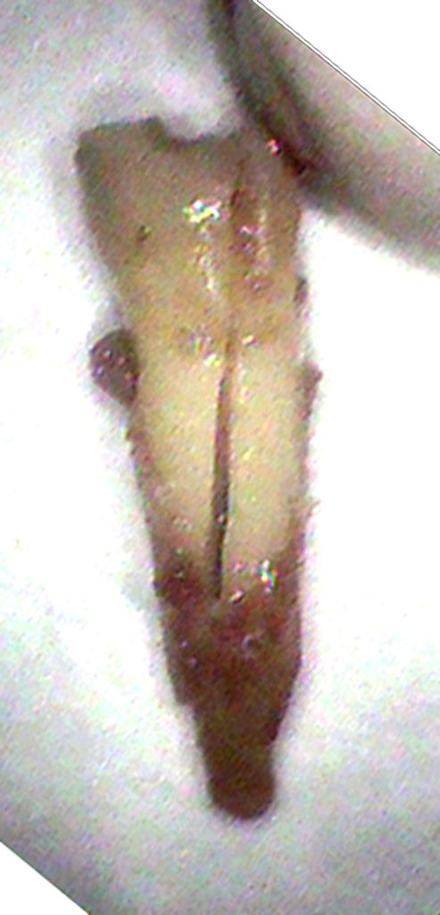 歯根破折|高松市で歯を残す治療なら吉本歯科医院