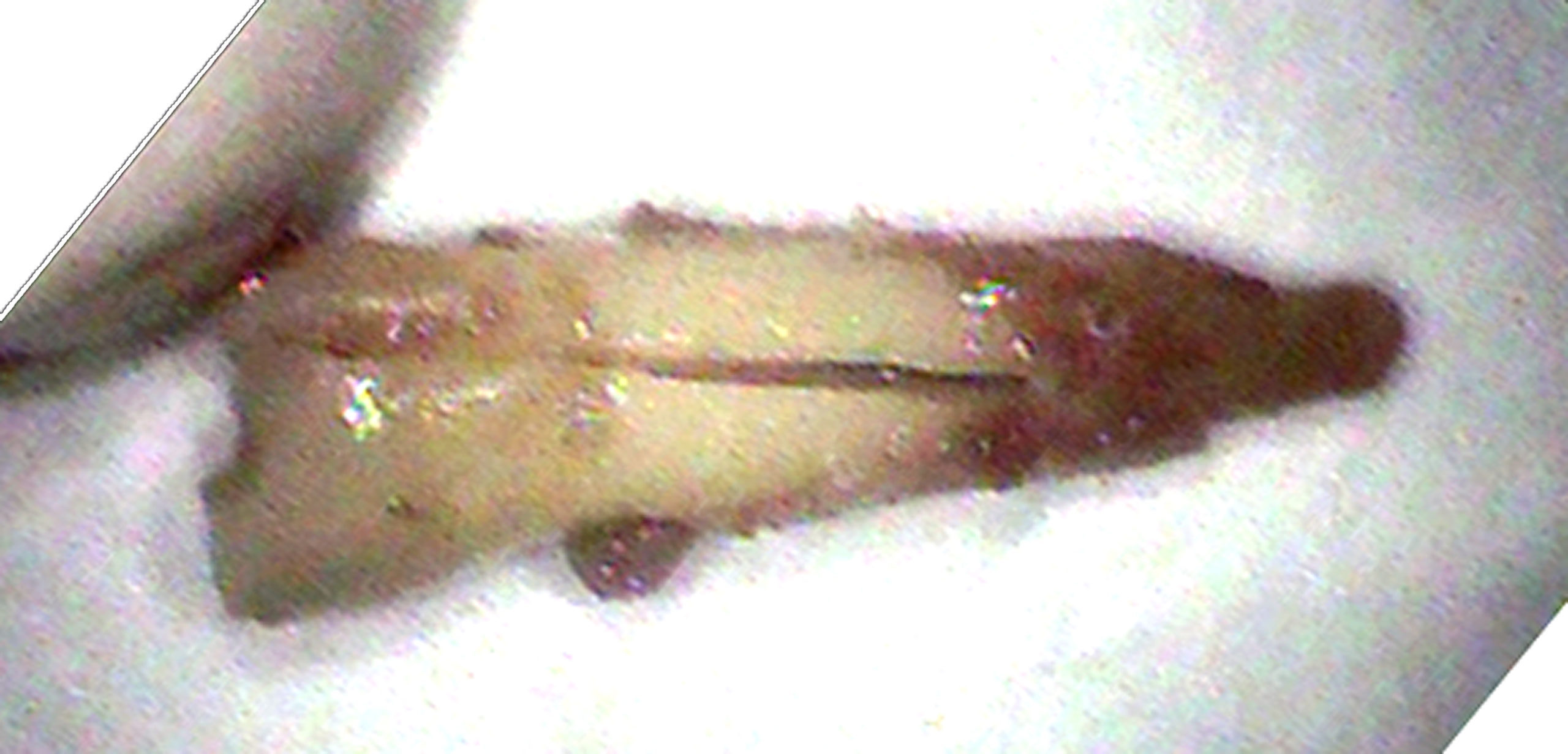 歯根破折|高松市で歯を残す治療なら吉本歯科医院